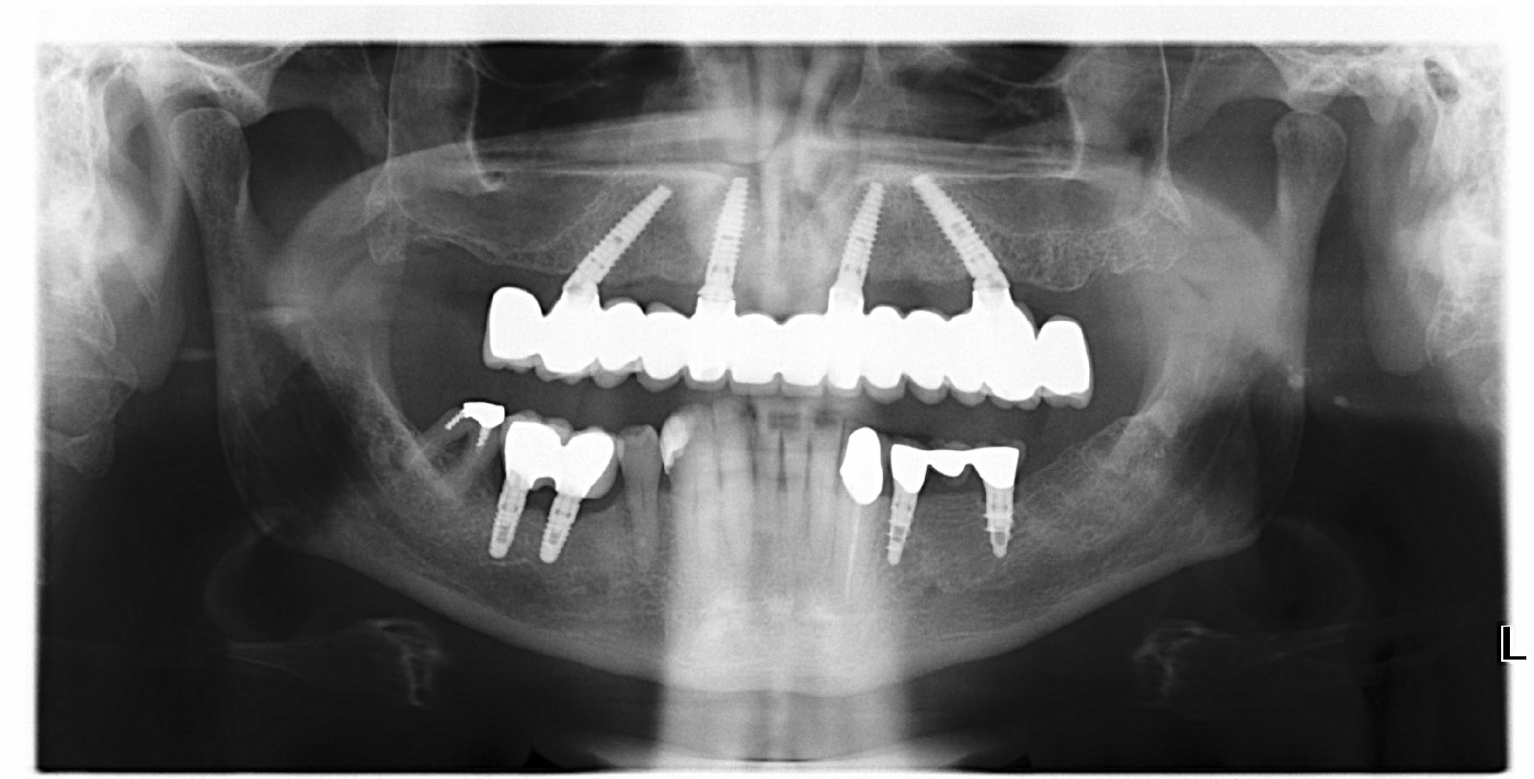 implantologia carico immediato cremona