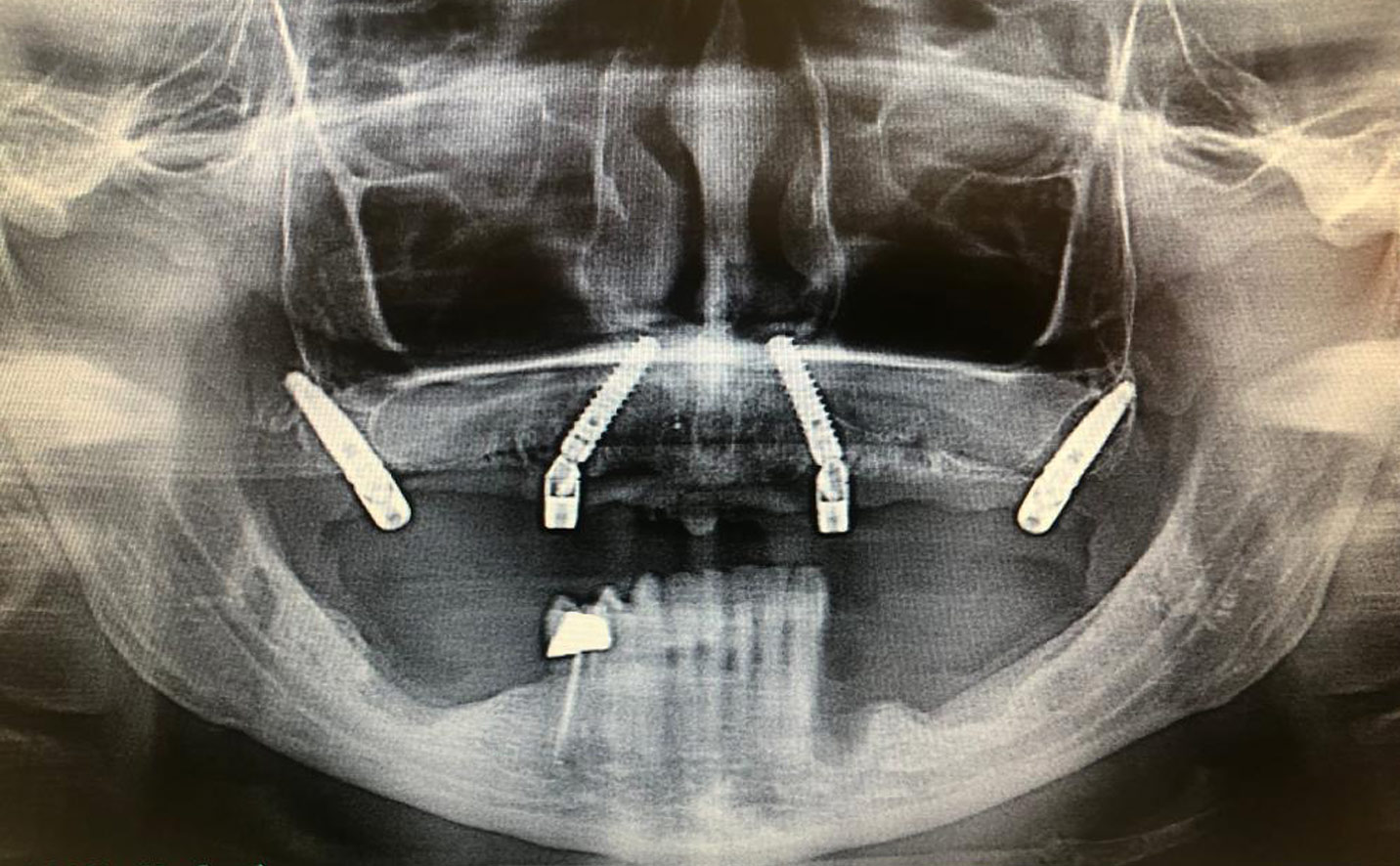 implantologia carico immediato cremona