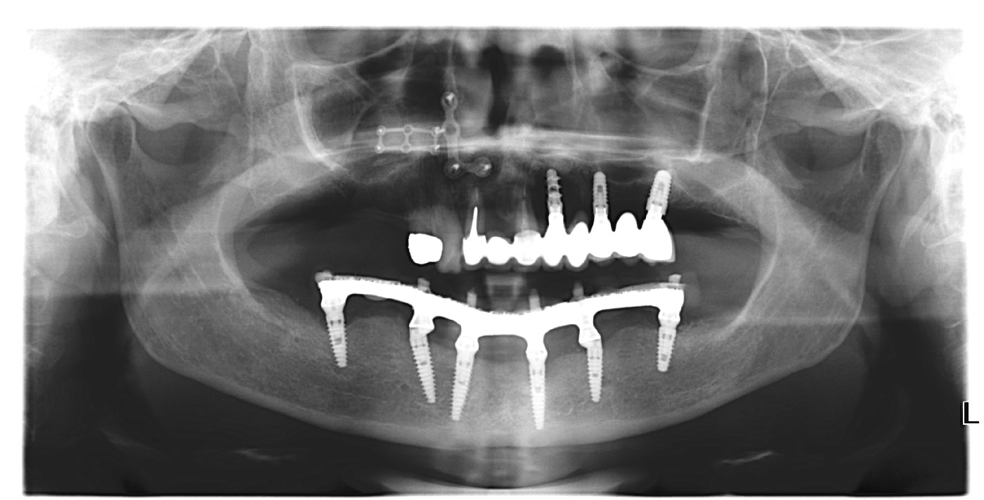 implantologia carico immediato cremona